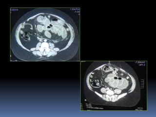 Cocoon abdomen | PPTX