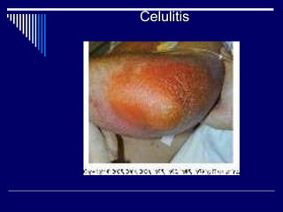 Celulitis 