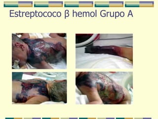 Estreptococo  β  hemol Grupo A 