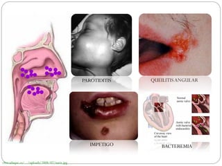 PAROTIDITIS   QUEILITIS ANGULAR




                                                   IMPETIGO      BACTEREMIA

clinicaduque.es/.../uploads/2008/07/nariz.jpg
 