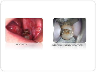 MUCOSITIS   INFECCIONES ENDODONTICAS
 