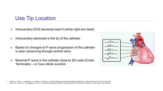 Electrocardiogram Tip Confirmation System.pdf Vascular Access Part 1: Reducing risk and increasing catheter longevity ...
