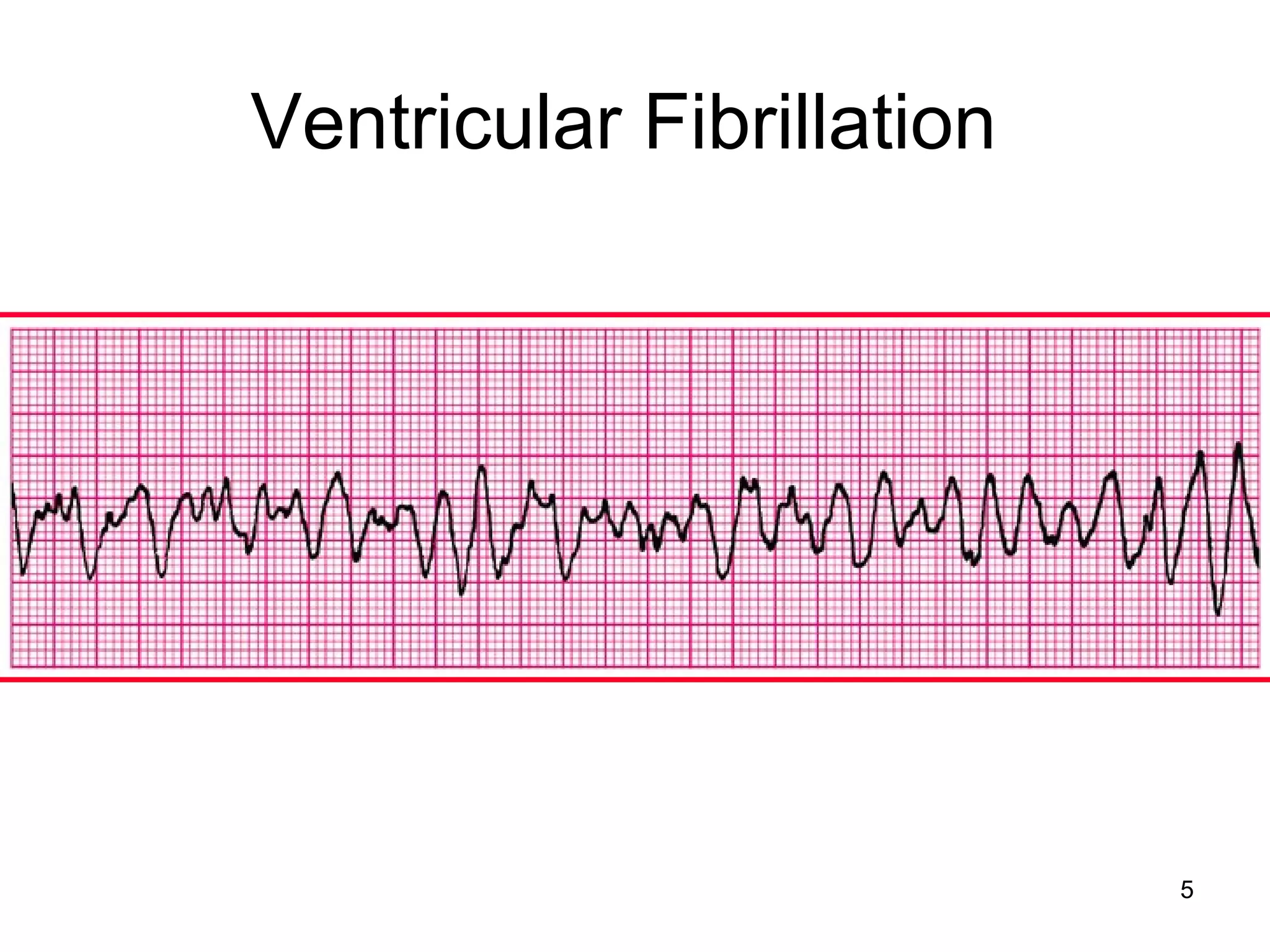 5
Ventricular Fibrillation
 
