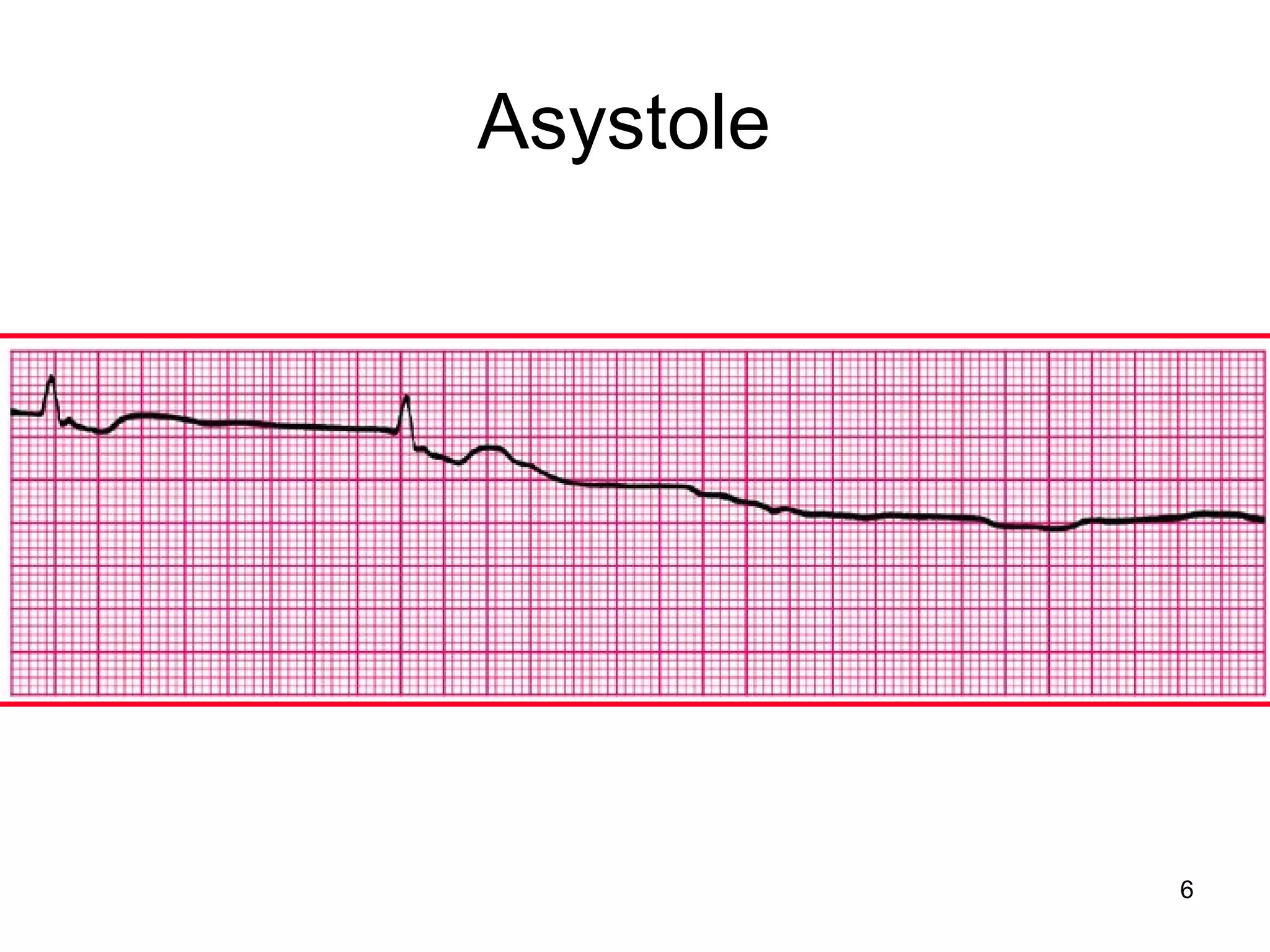 6
Asystole
 