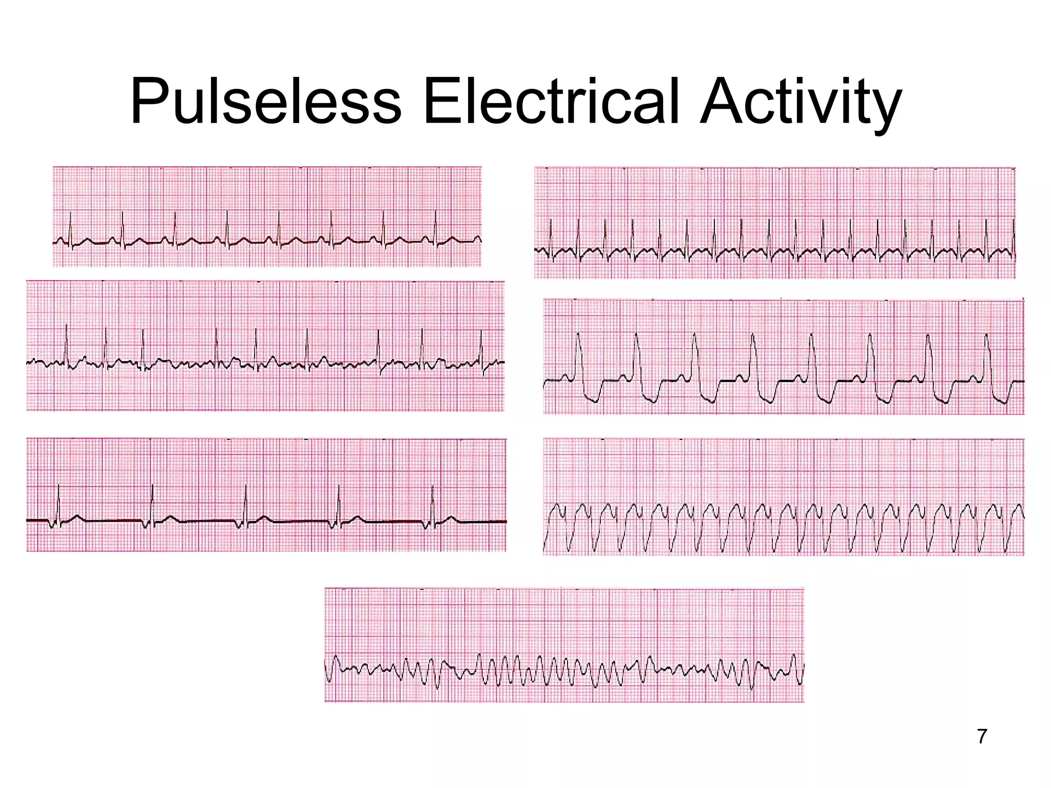 7
Pulseless Electrical Activity
 