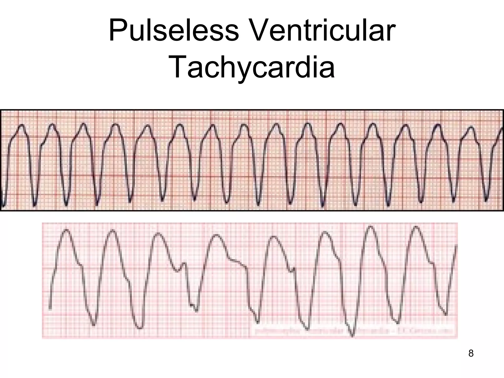8
Pulseless Ventricular
Tachycardia
 