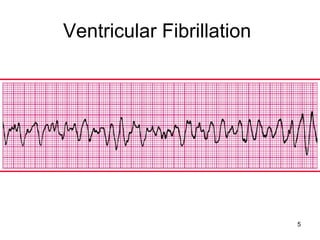 5
Ventricular Fibrillation
 