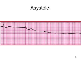 6
Asystole
 