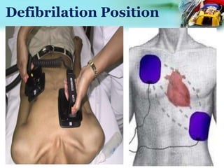 Defibrilation Position
 