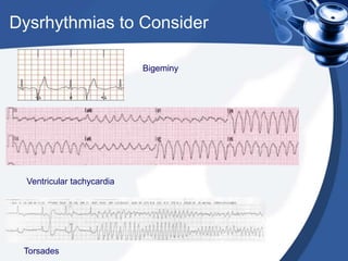 Dysrhythmias to Consider
Bigeminy
Ventricular tachycardia
Torsades
 