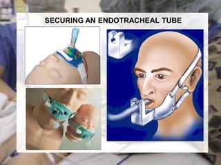 SECURING AN ENDOTRACHEAL TUBE
 