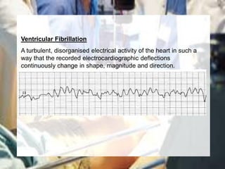Ventricular Fibrillation
A turbulent, disorganised electrical activity of the heart in such a
way that the recorded electrocardiographic deflections
continuously change in shape, magnitude and direction.
 