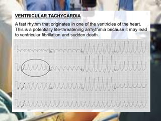 VENTRICULAR TACHYCARDIA
A fast rhythm that originates in one of the ventricles of the heart.
This is a potentially life-threatening arrhythmia because it may lead
to ventricular fibrillation and sudden death.
 