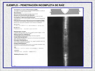EJEMPLO – PENETRACIÓN INCOMPLETA DE RAÍZ
 