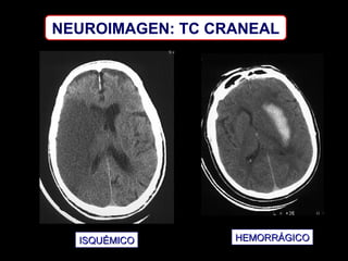 NEUROIMAGEN: TC CRANEAL

ISQUÉMICO

HEMORRÁGICO

 