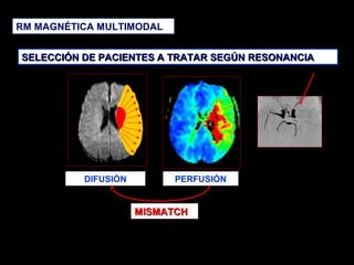 RM MAGNÉTICA MULTIMODAL
SELECCIÓN DE PACIENTES A TRATAR SEGÚN RESONANCIA

DIFUSIÓN

PERFUSIÓN

MISMATCH

 