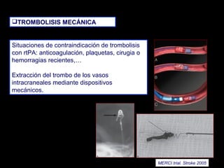TROMBOLISIS MECÁNICA

Situaciones de contraindicación de trombolisis
con rtPA: anticoagulación, plaquetas, cirugia o
hemorragias recientes,…
Extracción del trombo de los vasos
intracraneales mediante dispositivos
mecánicos.

MERCI trial. Stroke 2005

 
