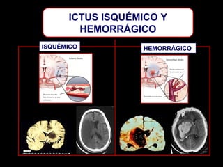 ICTUS ISQUÉMICO Y
HEMORRÁGICO
ISQUÉMICO

HEMORRÁGICO

 