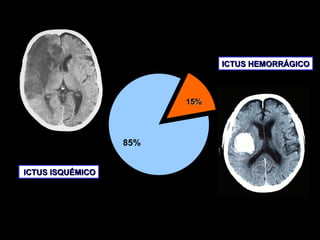 ICTUS HEMORRÁGICO

15%

85%
ICTUS ISQUÉMICO

 