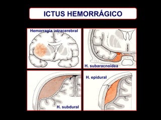 ICTUS HEMORRÁGICO
Hemorragia intracerebral

H. subaracnoidea
H. epidural

H. subdural

 