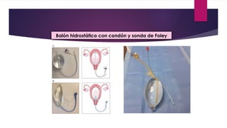 Balón hidrostático con condón y sonda de Foley
 