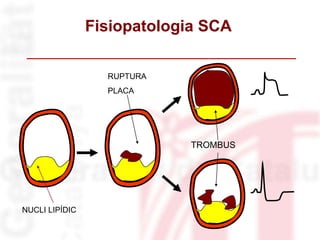 NUCLI LIPÍDIC
RUPTURA
PLACA
TROMBUS
Fisiopatologia SCA
 