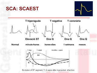 SCA: SCAEST
Normal minuts-hores hores-dies 1 setmana mesos
Elevació ST Ona Q Ona Q Ona Q
T hiperaguda T negativa T coronària
 