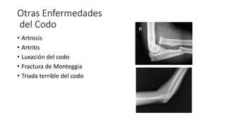 Otras Enfermedades 
del Codo 
• Artrosis 
• Artritis 
• Luxación del codo 
• Fractura de Monteggia 
• Triada terrible del codo 
