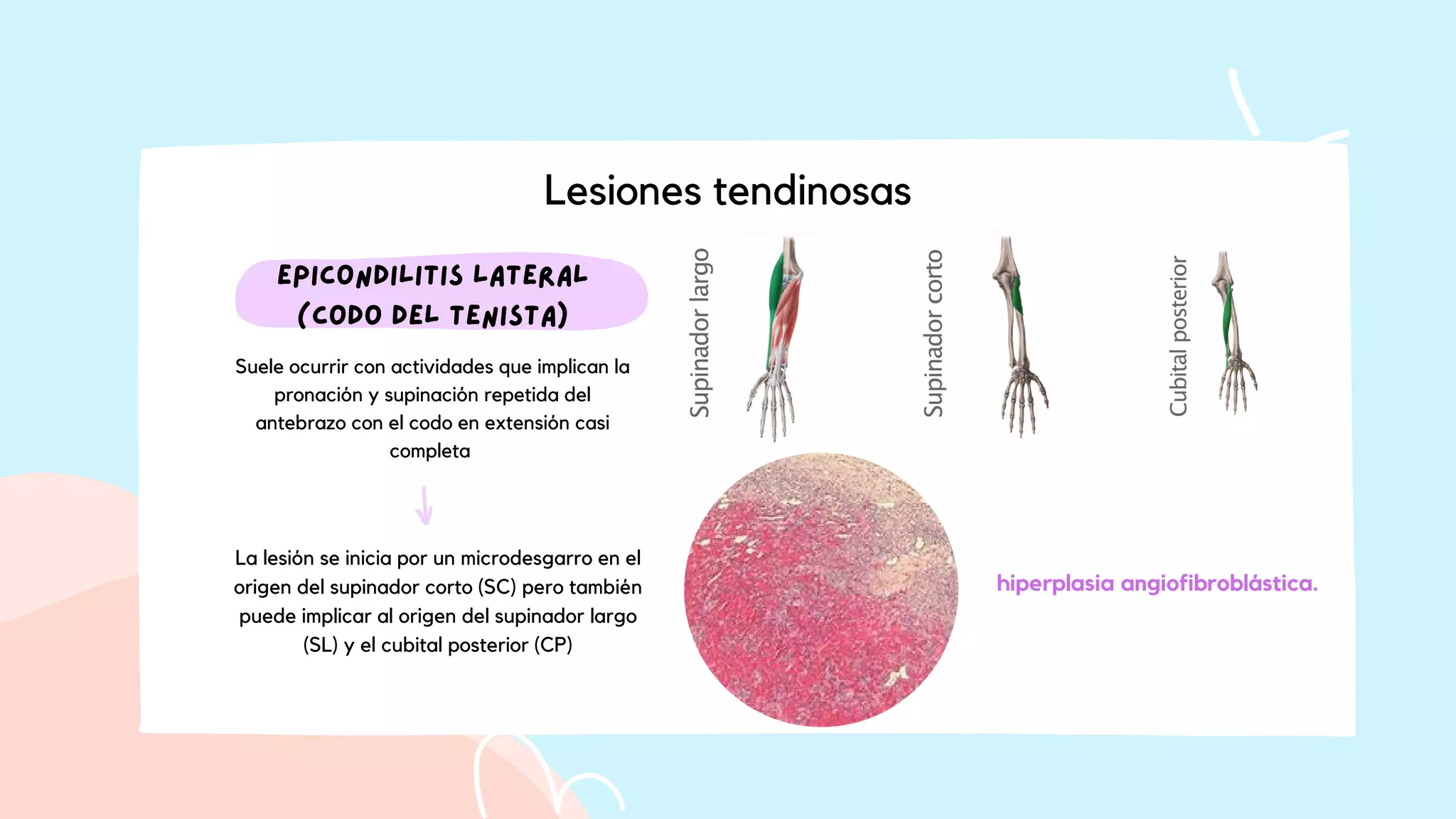 _Codo. (codo de las pequeñas ligas, epicondilitis lateral ...