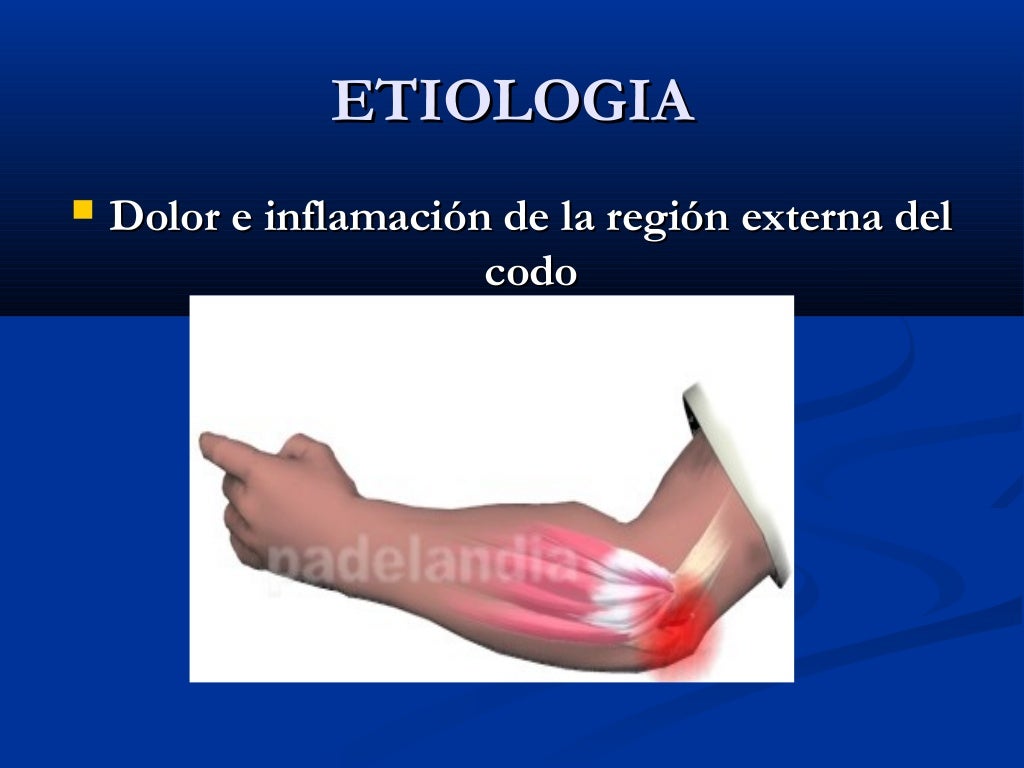 Epicondilitis Grado 2 Grado De Minusvalía Codo de tenista epicondilitis