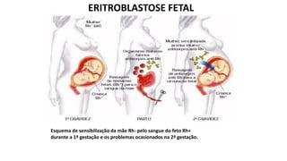 ERITROBLASTOSE FETAL
Esquema de sensibilização da mãe Rh- pelo sangue do feto Rh+
durante a 1ª gestação e os problemas ocasionados na 2ª gestação.
 