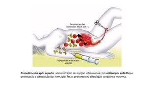 Procedimento após o parto: administração de injeção intravenosa com anticorpos anti-Rhque
provocarão a destruição das hemácias fetais presentes na circulação sangüínea materna.
 