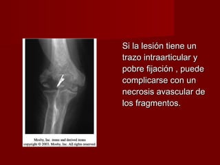 Si la lesión tiene un
trazo intraarticular y
pobre fijación , puede
complicarse con un
necrosis avascular de
los fragmentos.
 