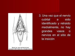 3. Una vez que el nervio
  cubital     a      sido
  identificado y retraido
  medialmente, no hay
  grandes     vasos     o
  nervios en el sitio de
  la insición
 