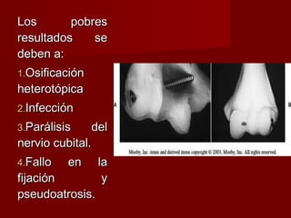 Los       pobres
resultados    se
deben a:
1.Osificación
heterotópica
2.Infección
3.Parálisis     del
nervio cubital.
4.Fallo   en     la
fijación          y
pseudoatrosis.
 