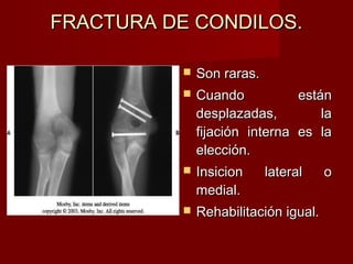 FRACTURA DE CONDILOS.

             Son raras.
             Cuando             están
              desplazadas,           la
              fijación interna   es la
              elección.
             Insicion     lateral    o
              medial.
             Rehabilitación igual.
 