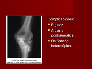 Complicaciones:
   Rigidez.
   Artrosis
    postraumatica.
   Osificación
    heterotópica.
 