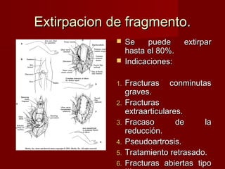 Extirpacion de fragmento.
              Se    puede        extirpar
               hasta el 80%.
              Indicaciones:


             1.   Fracturas conminutas
                  graves.
             2.   Fracturas
                  extraarticulares.
             3.   Fracaso        de     la
                  reducción.
             4.   Pseudoartrosis.
             5.   Tratamiento retrasado.
             6.   Fracturas abiertas tipo
 