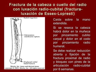 Fractura de la cabeza o cuello del radio
  con luxación radio-cubital (fractura-
      luxación de Essex-Lopresti)
                      Caida sobre la mano
                      extendida.
                      Si se reseca la cabeza
                      habrá dolor en la muñeca
                      por pinzamiento cubito
                      carpal y dolor en el codo
                      por pinzamiento radio
                      humeral.
                      Se debe realizar reducción
                      abierta y fijación de la
                      fractura proximal de radio
                      y bloqueo con pines de la
                      articulación   radio-cubital
                      por 6 semanas.
 