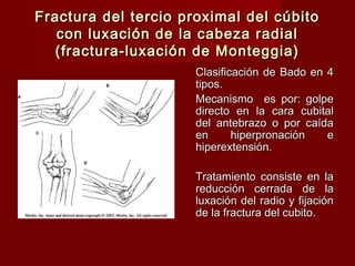 Fractura del tercio proximal del cúbito
   con luxación de la cabeza radial
  (fractura-luxación de Monteggia)
                      Clasificación de Bado en 4
                      tipos.
                      Mecanismo es por: golpe
                      directo en la cara cubital
                      del antebrazo o por caída
                      en      hiperpronación   e
                      hiperextensión.

                      Tratamiento consiste en la
                      reducción cerrada de la
                      luxación del radio y fijación
                      de la fractura del cubito.
 