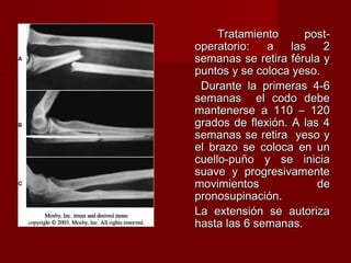 Tratamiento      post-
operatorio:   a    las   2
semanas se retira férula y
puntos y se coloca yeso.
 Durante la primeras 4-6
semanas el codo debe
mantenerse a 110 – 120
grados de flexión. A las 4
semanas se retira yeso y
el brazo se coloca en un
cuello-puño y se inicia
suave y progresivamente
movimientos             de
pronosupinación.
La extensión se autoriza
hasta las 6 semanas.
 