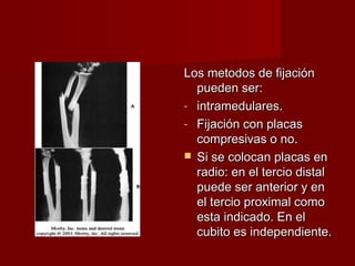 Los metodos de fijación
  pueden ser:
- intramedulares.
- Fijación con placas
  compresivas o no.
 Si se colocan placas en
  radio: en el tercio distal
  puede ser anterior y en
  el tercio proximal como
  esta indicado. En el
  cubito es independiente.
 