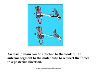 An elastic chain can be attached to the hook of the
anterior segment to the molar tube to redirect the forces
in a posteri...