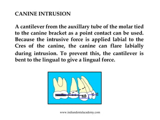 CANINE INTRUSION
A cantilever from the auxillary tube of the molar tied
to the canine bracket as a point contact can be us...