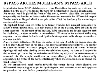 BYPASS ARCHES MULLIGAN’S BYPASS ARCH
Is fabricated from 0.016” stainless steel wire. Bracketing the anterior teeth may be
...