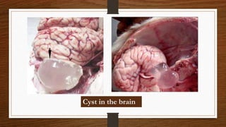 Cyst in the brain
 