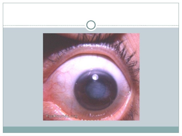 Cogan's Syndrome - a very rare disorder that I was fortunate to see Cogan's Syndrome - a very rare disorder that I was fortunate to see