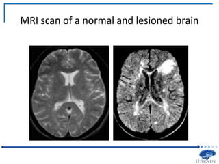 MRI scan of a normal and lesioned brain
 