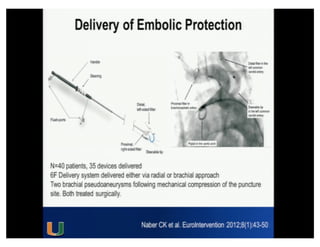 Cohen MG - AIMRADIAL 2014 - Radial and TAVI