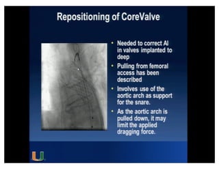 Cohen MG - AIMRADIAL 2014 - Radial and TAVI